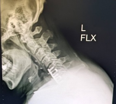 Name:  Neck X-Ray, L-Flex, Jun 2022 - cropped.jpg
Views: 1231
Size:  30.2 KB